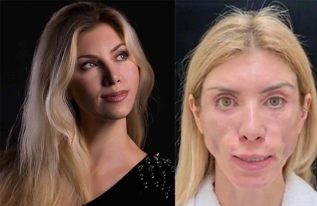 Who Is Yulia Tarasevich? Russian Beauty Queen Was Left Unable To Close Her  Eyes Or Smile After Undergoing £3,000 Surgery - TheRecentTimes