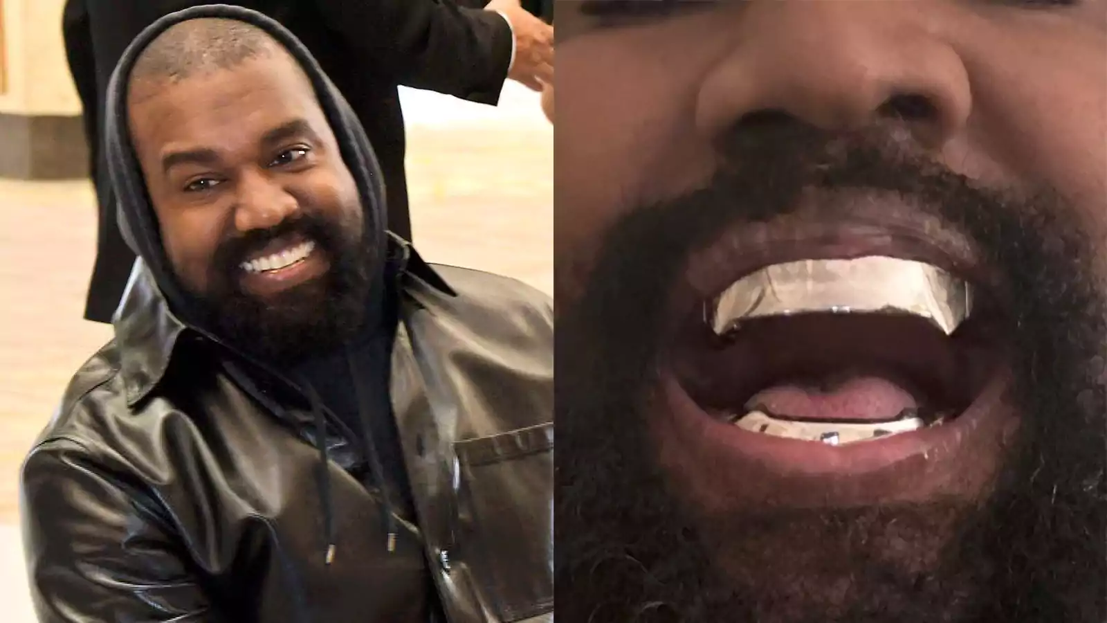 Kanye West Unveils $850K Titanium Dentures, Sparking Comparisons to ...